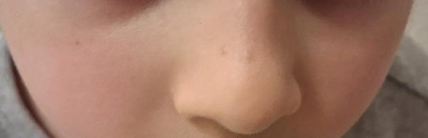 Bild zu Zwei hartnäckige Mitesser - Haut von Babys und Kindern ✔️ Expertenforum