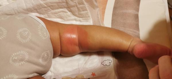 Bild zu Bauch komplett voll mit roten trockenen Stellen - was hilft meinem Kind und was hat es? - Haut von Babys und Kindern ✔️ Expertenforum