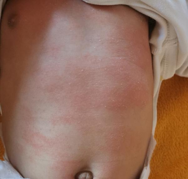 Bild zu Bauch komplett voll mit roten trockenen Stellen - was hilft meinem Kind und was hat es? - Haut von Babys und Kindern ✔️ Expertenforum