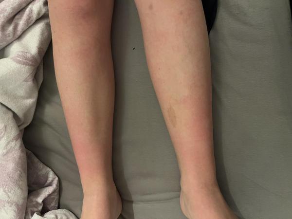 Bild zu Rote brennende Haut nach dem Duschen - Haut von Babys und Kindern ✔️ Expertenforum