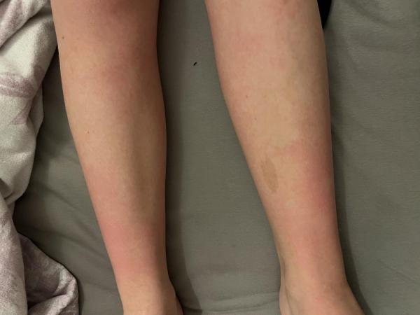 Bild zu Rote brennende Haut nach dem Duschen - Haut von Babys und Kindern ✔️ Expertenforum