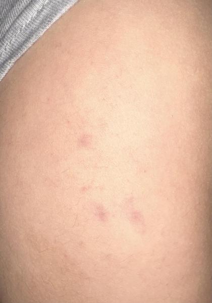 Bild zu hämatome und Petechien - Haut von Babys und Kindern ✔️ Expertenforum