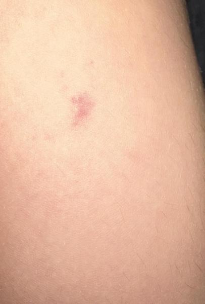 Bild zu hämatome und Petechien - Haut von Babys und Kindern ✔️ Expertenforum