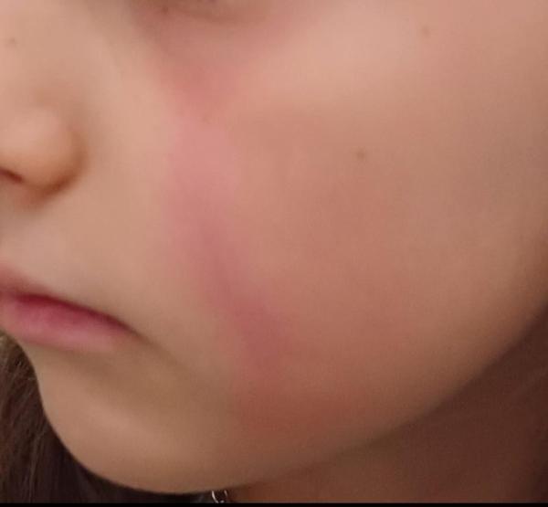 Bild zu Ausschlag im Gesicht/roter Streifen - Haut von Babys und Kindern ✔️ Expertenforum