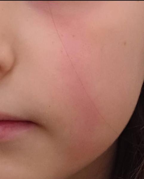 Bild zu Ausschlag im Gesicht/roter Streifen - Haut von Babys und Kindern ✔️ Expertenforum