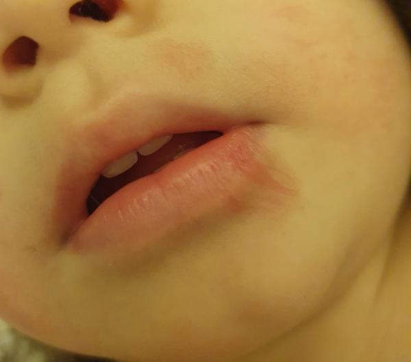 Bild zu Rötung untere Lippenbereich - Haut von Babys und Kindern ✔️ Expertenforum