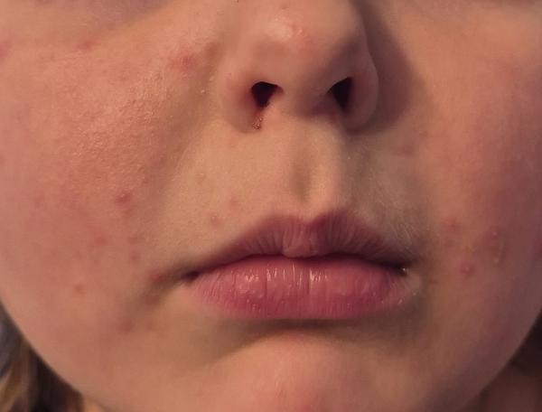 Bild zu Dermatitis? - Haut von Babys und Kindern ✔️ Expertenforum