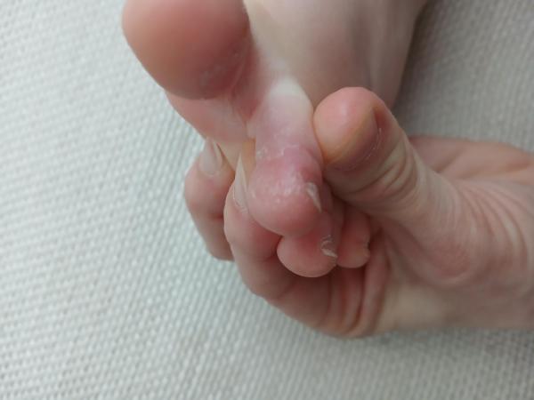 Bild zu Schuppige Haut Zeh - Haut von Babys und Kindern ✔️ Expertenforum