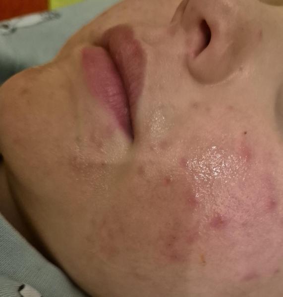 Bild zu Dermatitis? - Haut von Babys und Kindern ✔️ Expertenforum