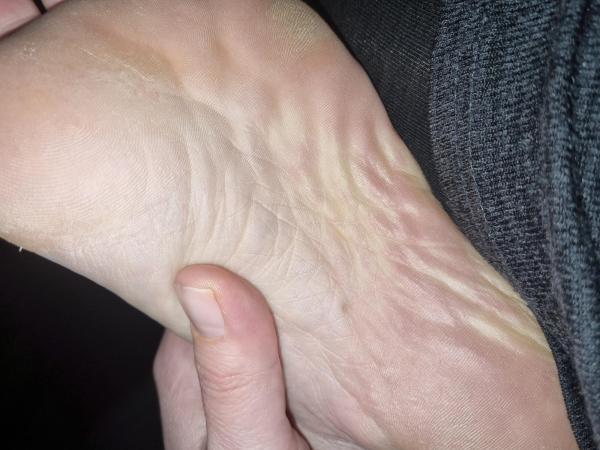 Bild zu Muttermal an der Fußsohle - Haut von Babys und Kindern ✔️ Expertenforum