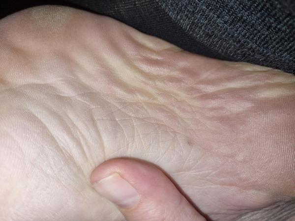 Bild zu Muttermal an der Fußsohle - Haut von Babys und Kindern ✔️ Expertenforum