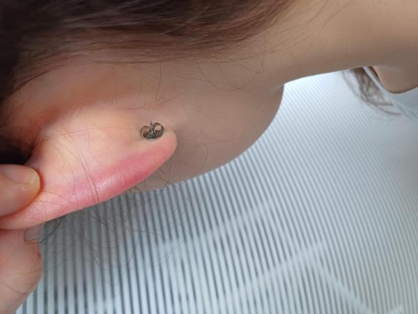 Bild zu Rotes,schmerzendes Ohrläppchen - Haut von Babys und Kindern ✔️ Expertenforum