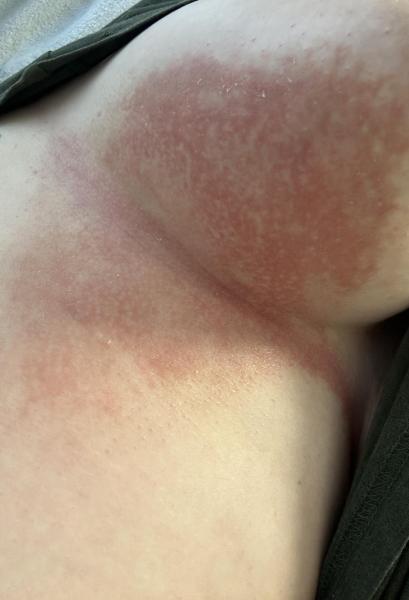 Bild zu Pilzinfektion bei stillender Mutter? - Haut von Babys und Kindern ✔️ Expertenforum