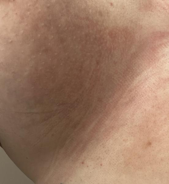 Bild zu Ausschlag stillende Mutter - Haut von Babys und Kindern ✔️ Expertenforum