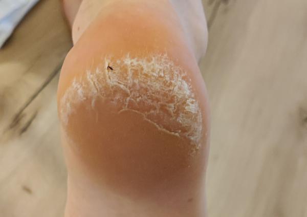 Bild zu Hornhaut oder Fußpilz? - Haut von Babys und Kindern ✔️ Expertenforum