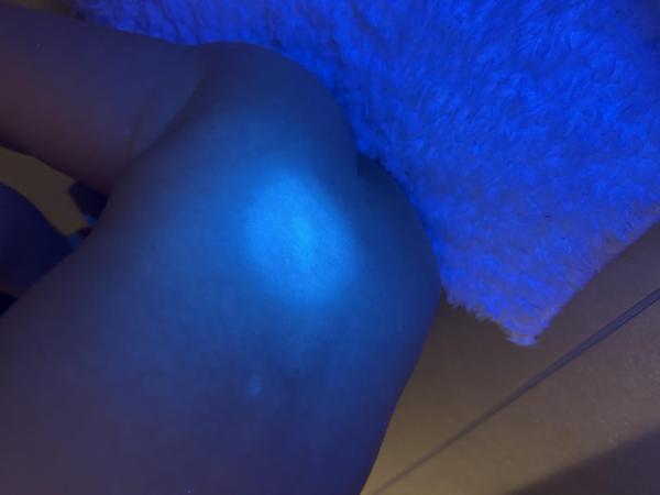 Bild zu Hypopigmentierte Flecken - Haut von Babys und Kindern ✔️ Expertenforum