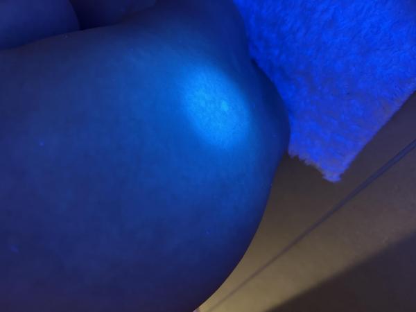 Bild zu Hypopigmentierte Flecken - Haut von Babys und Kindern ✔️ Expertenforum