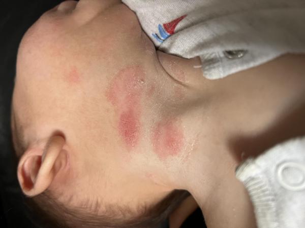 Bild zu Nässende Stellen in Halsfalte - Haut von Babys und Kindern ✔️ Expertenforum