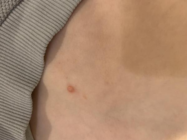 Bild zu Behandlung Dell-Warzen - Haut von Babys und Kindern ✔️ Expertenforum