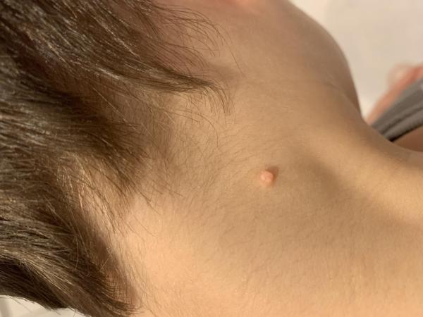 Bild zu Behandlung Dell-Warzen - Haut von Babys und Kindern ✔️ Expertenforum