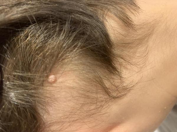 Bild zu Behandlung Dell-Warzen - Haut von Babys und Kindern ✔️ Expertenforum