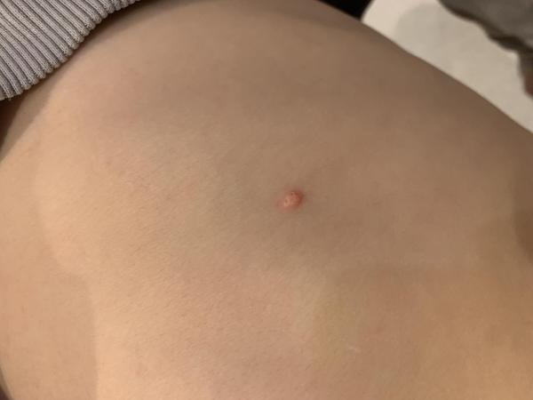 Bild zu Behandlung Dell-Warzen - Haut von Babys und Kindern ✔️ Expertenforum