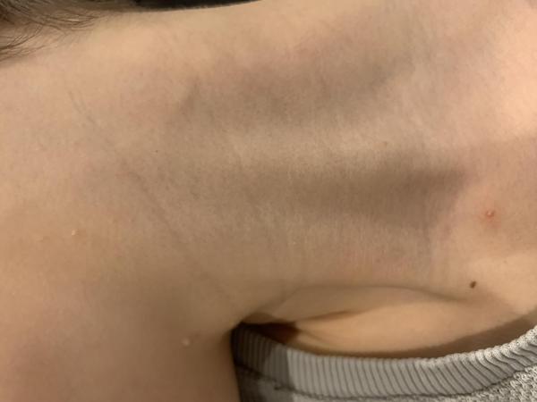 Bild zu Behandlung Dell-Warzen - Haut von Babys und Kindern ✔️ Expertenforum