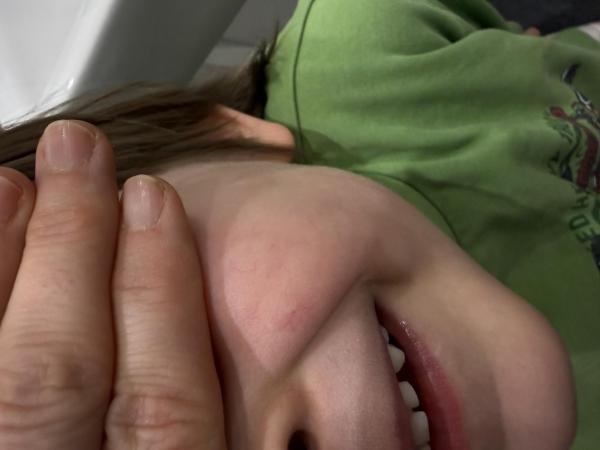 Bild zu Immer mehr Besenreißer - Haut von Babys und Kindern ✔️ Expertenforum