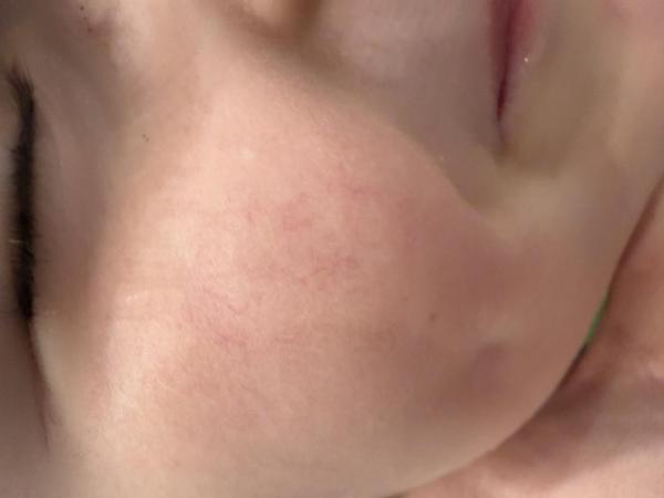 Bild zu Immer mehr Besenreißer - Haut von Babys und Kindern ✔️ Expertenforum