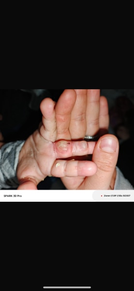 Bild zu Wiederkehrende Blasen - Haut von Babys und Kindern ✔️ Expertenforum