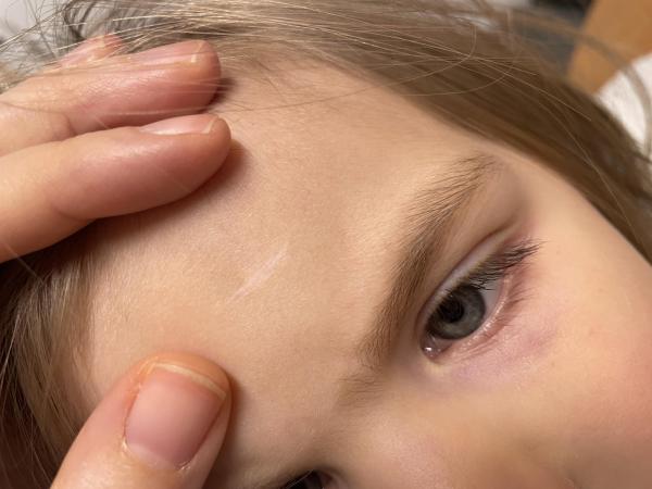 Bild zu Narbe Stirn breiter geworden - Haut von Babys und Kindern ✔️ Expertenforum
