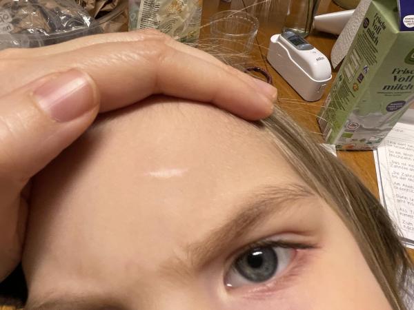 Bild zu Narbe Stirn breiter geworden - Haut von Babys und Kindern ✔️ Expertenforum