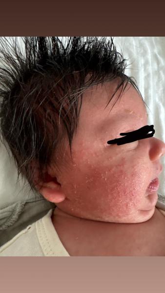 Bild zu Trockene Haut - Haut von Babys und Kindern ✔️ Expertenforum