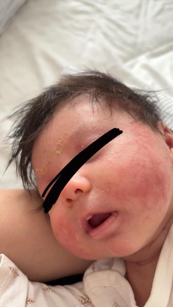 Bild zu Trockene Haut - Haut von Babys und Kindern ✔️ Expertenforum