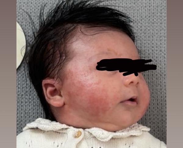 Bild zu Trockene Haut - Haut von Babys und Kindern ✔️ Expertenforum