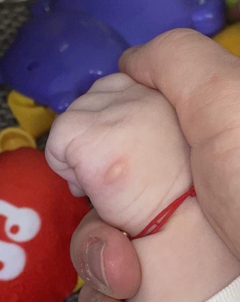 Bild zu 5 Monate altes Baby Blase auf einer Vernarbung und Rötung am Bauch und Rücken - Haut von Babys und Kindern ✔️ Expertenforum