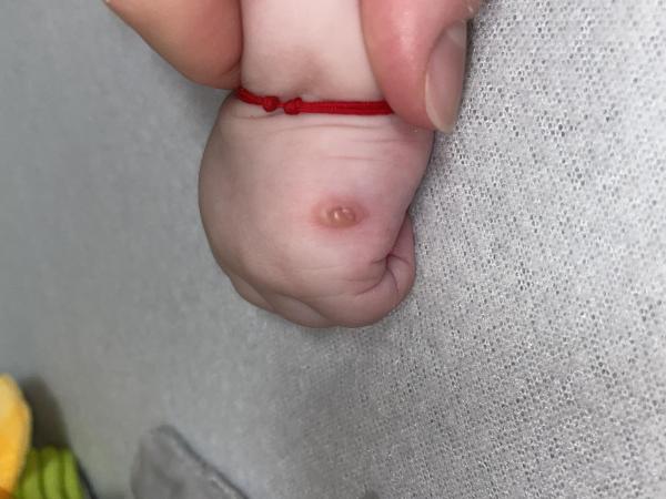 Bild zu 5 Monate altes Baby Blase auf einer Vernarbung und Rötung am Bauch und Rücken - Haut von Babys und Kindern ✔️ Expertenforum