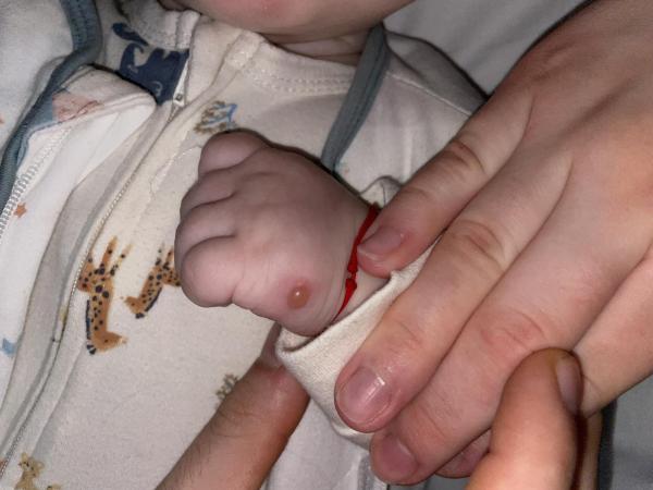 Bild zu 5 Monate altes Baby Blase auf einer Vernarbung und Rötung am Bauch und Rücken - Haut von Babys und Kindern ✔️ Expertenforum