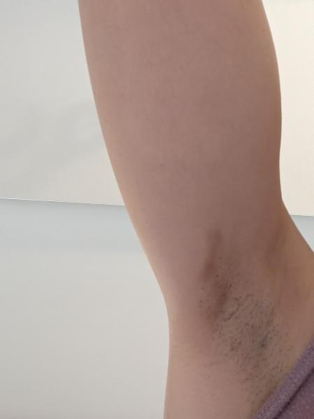 Bild zu Dunkler Fleck unterm Arm - Haut von Babys und Kindern ✔️ Expertenforum