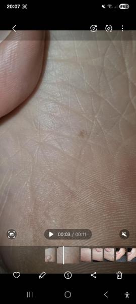 Bild zu Muttermal an der Fußsohle - Haut von Babys und Kindern ✔️ Expertenforum