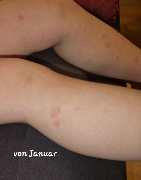 Bild zu Frage - Haut von Babys und Kindern ✔️ Expertenforum