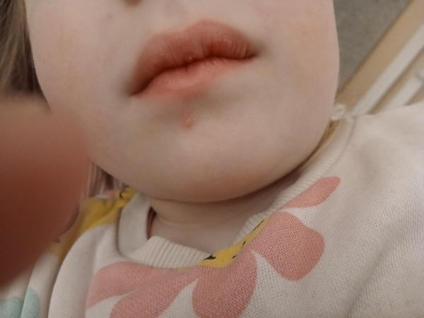 Bild zu Pickelchen - Haut von Babys und Kindern ✔️ Expertenforum