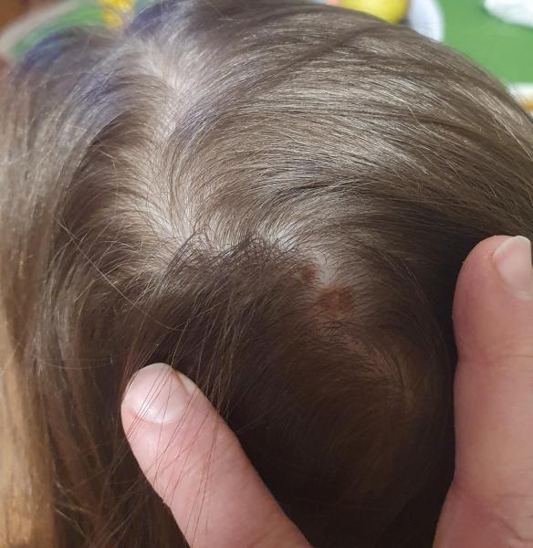 Bild zu Muttermal/Kopf - Haut von Babys und Kindern ✔️ Expertenforum