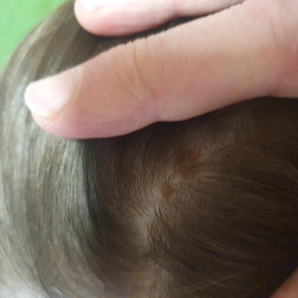 Bild zu Muttermal/Kopf - Haut von Babys und Kindern ✔️ Expertenforum