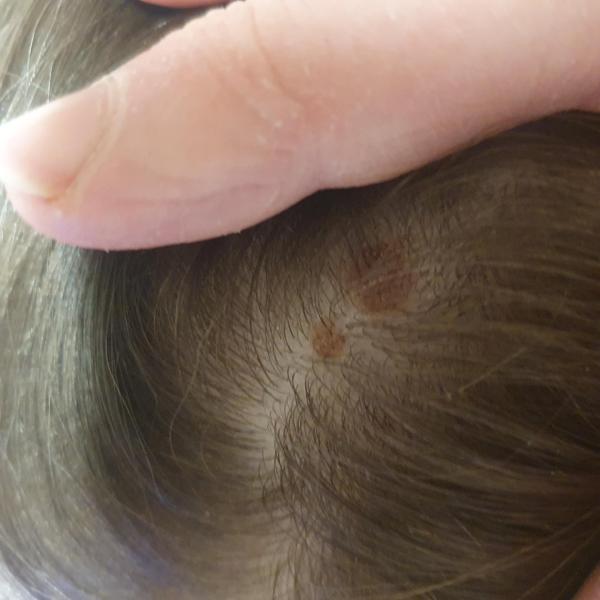 Bild zu Muttermal/Kopf - Haut von Babys und Kindern ✔️ Expertenforum