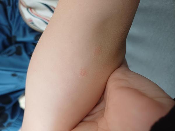 Bild zu Ellenbogen - Haut von Babys und Kindern ✔️ Expertenforum