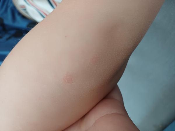 Bild zu Ellenbogen - Haut von Babys und Kindern ✔️ Expertenforum