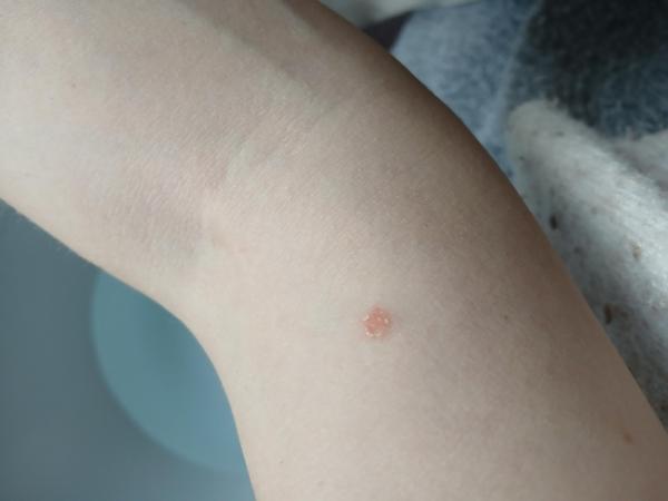 Bild zu Flecken - Haut von Babys und Kindern ✔️ Expertenforum