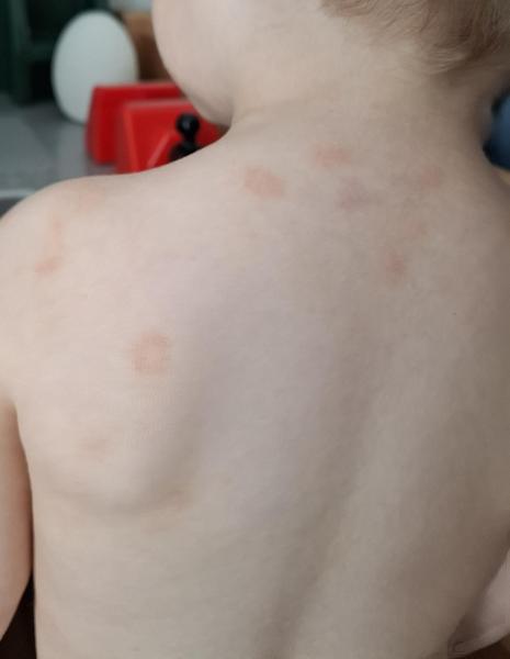 Bild zu kreisrunde trockene Stellen Teil 2 - Haut von Babys und Kindern ✔️ Expertenforum