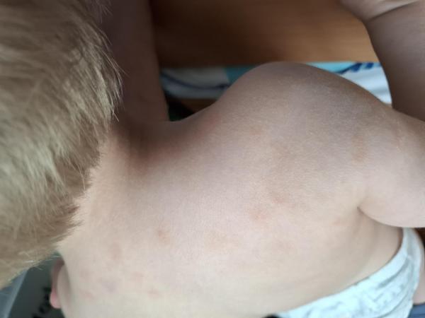 Bild zu kreisrunde trockene Stellen Teil 2 - Haut von Babys und Kindern ✔️ Expertenforum